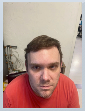 After hair transplant