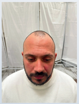 Before hair transplant