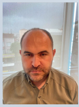 Before hair transplant