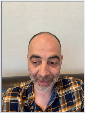 Before hair transplant