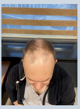 Before hair transplant